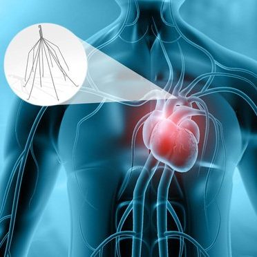 IVC Filters: What you need to know