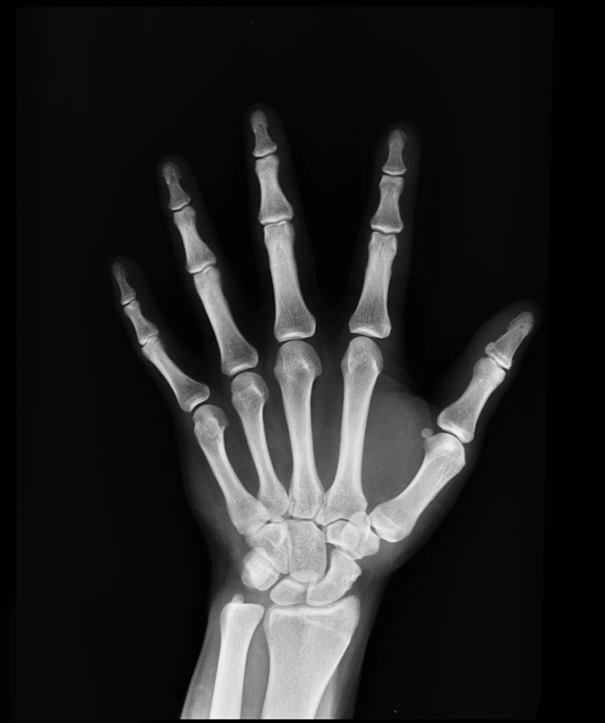 X-Ray of individual's hand